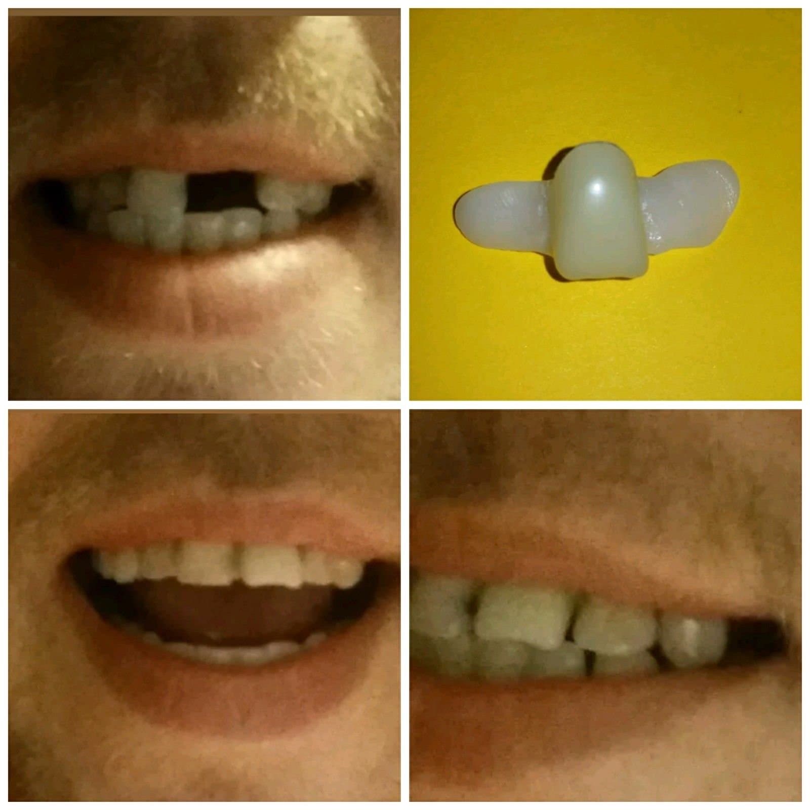 DIY * Temporary Replacement Front Tooth Central Incisor